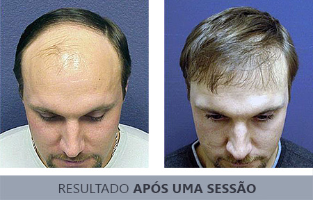 Resultado após uma sessão de transplante capilar realizado na clínica Ponto Cabelo.